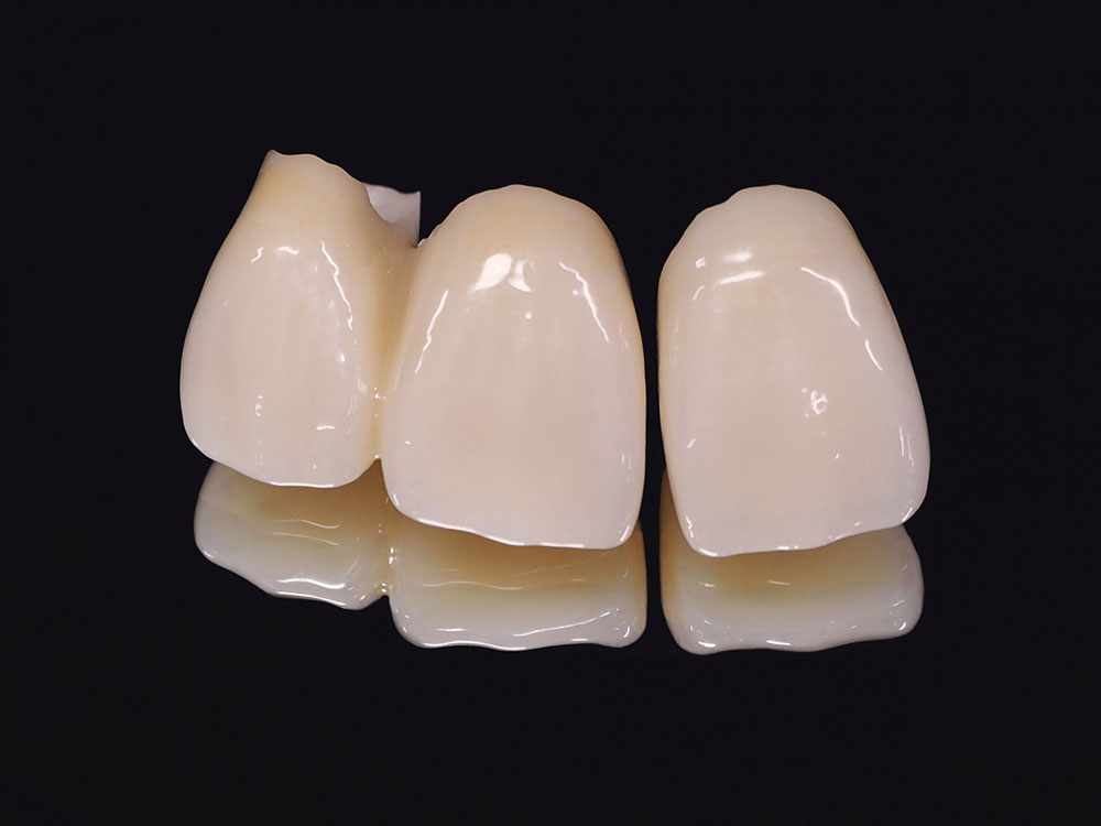 オールセラミック